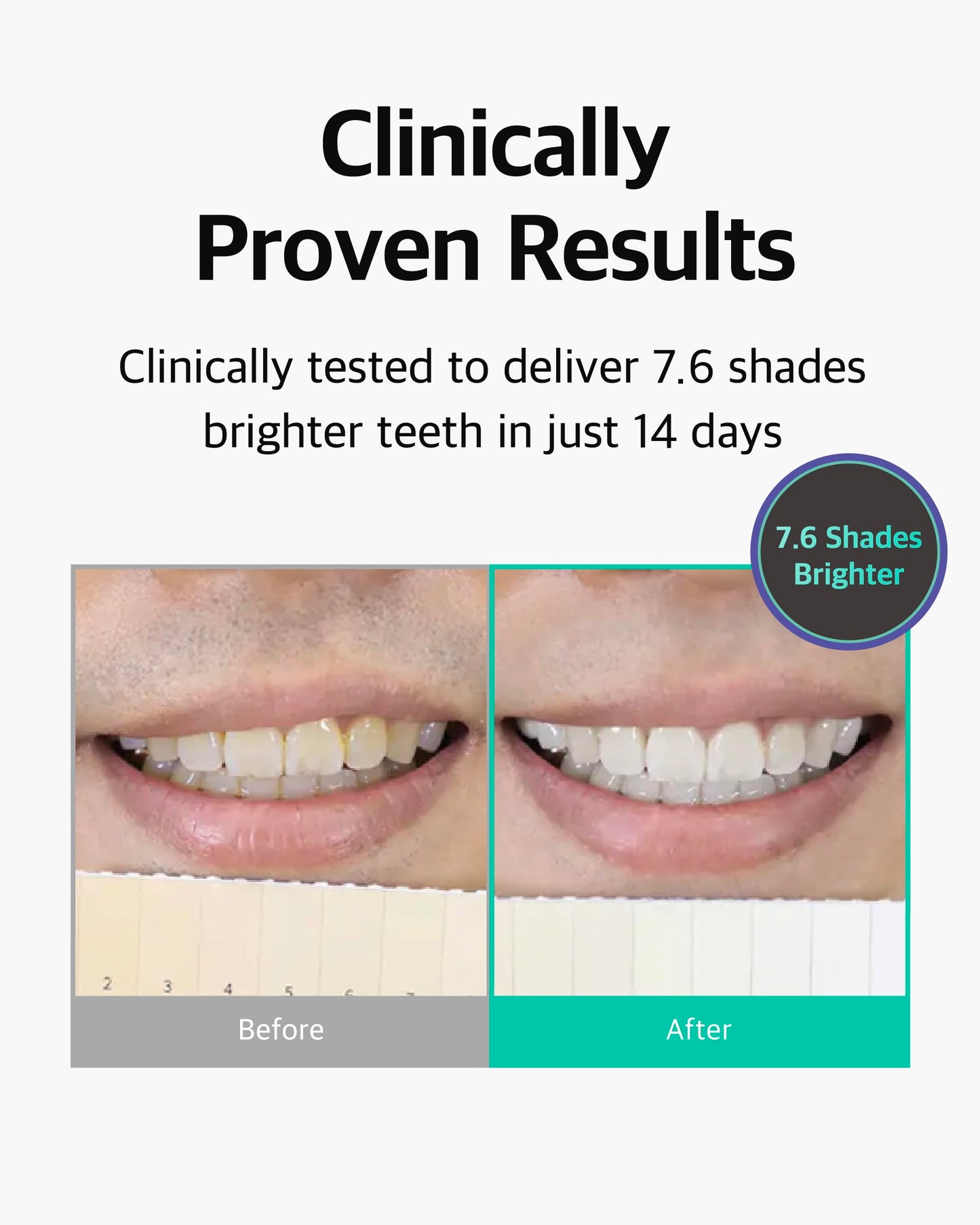 Live Orals PureDia Teeth Whitening Kit - Gel & Mouthpiece Set, Hydrogen Peroxide, Dentist Formulated for Sensitive Teeth, 28 Treatments.